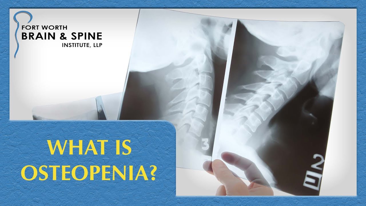 Fort Worth Brain and Spine Institute - What is Osteopenia?