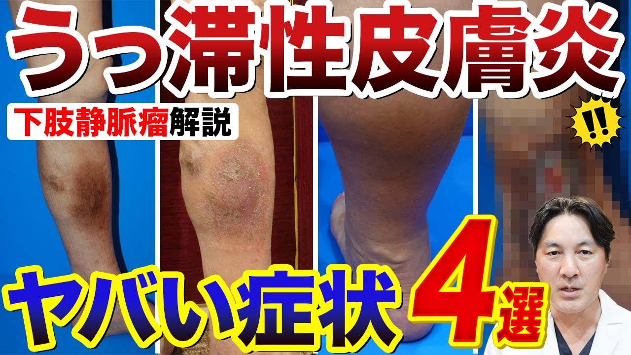 ボコボコしていない静脈瘤もある？特にうっ滞性皮膚炎に注意