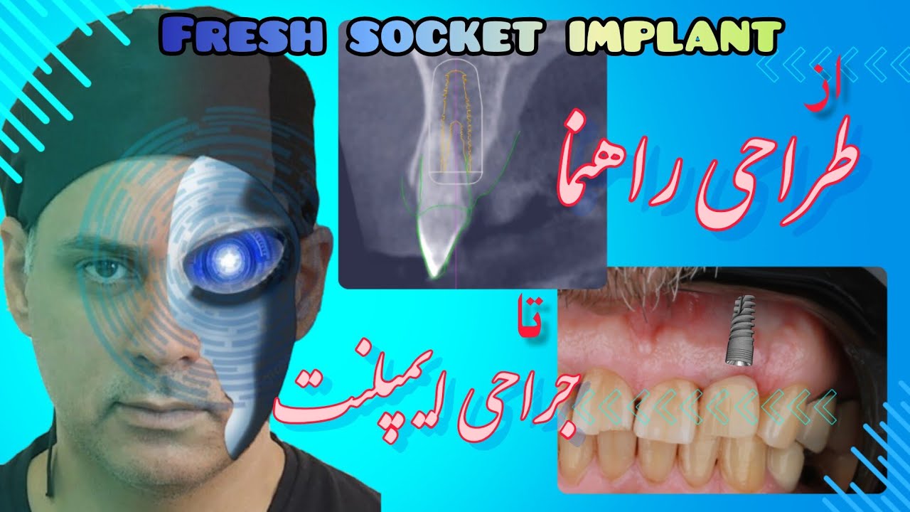 طراحی راهنمای جراحی ایمپلنت در برنامه اگزوکد اگزوپلن | ایمپلنت فوری پس از کشیدن دندان در ناجیه قدامی