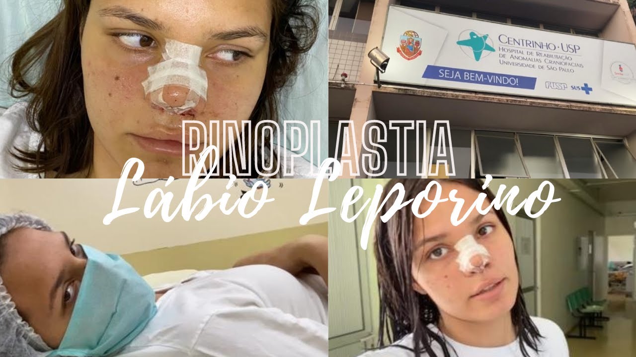 Cirurgia de rinoplastia / centrinho Bauru USP/ lábio leporino ❤️