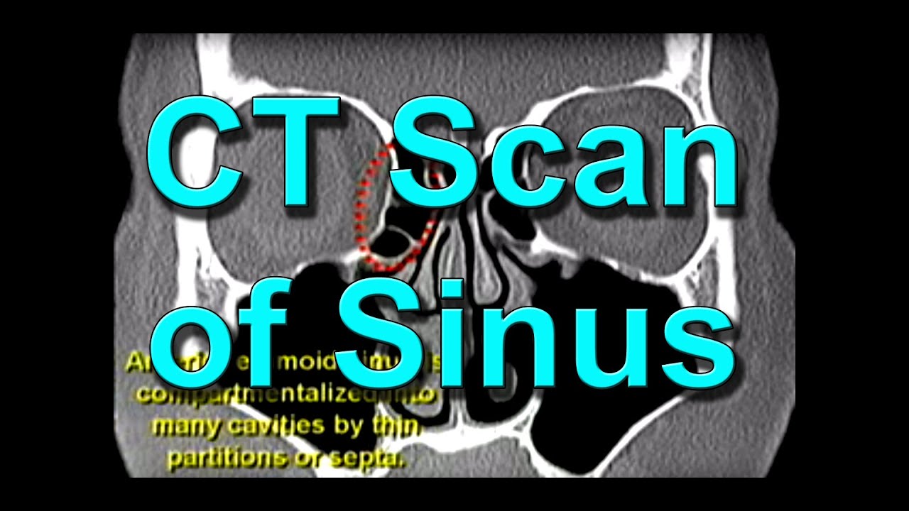 How To Read CT Sinus Scans Like An Expert