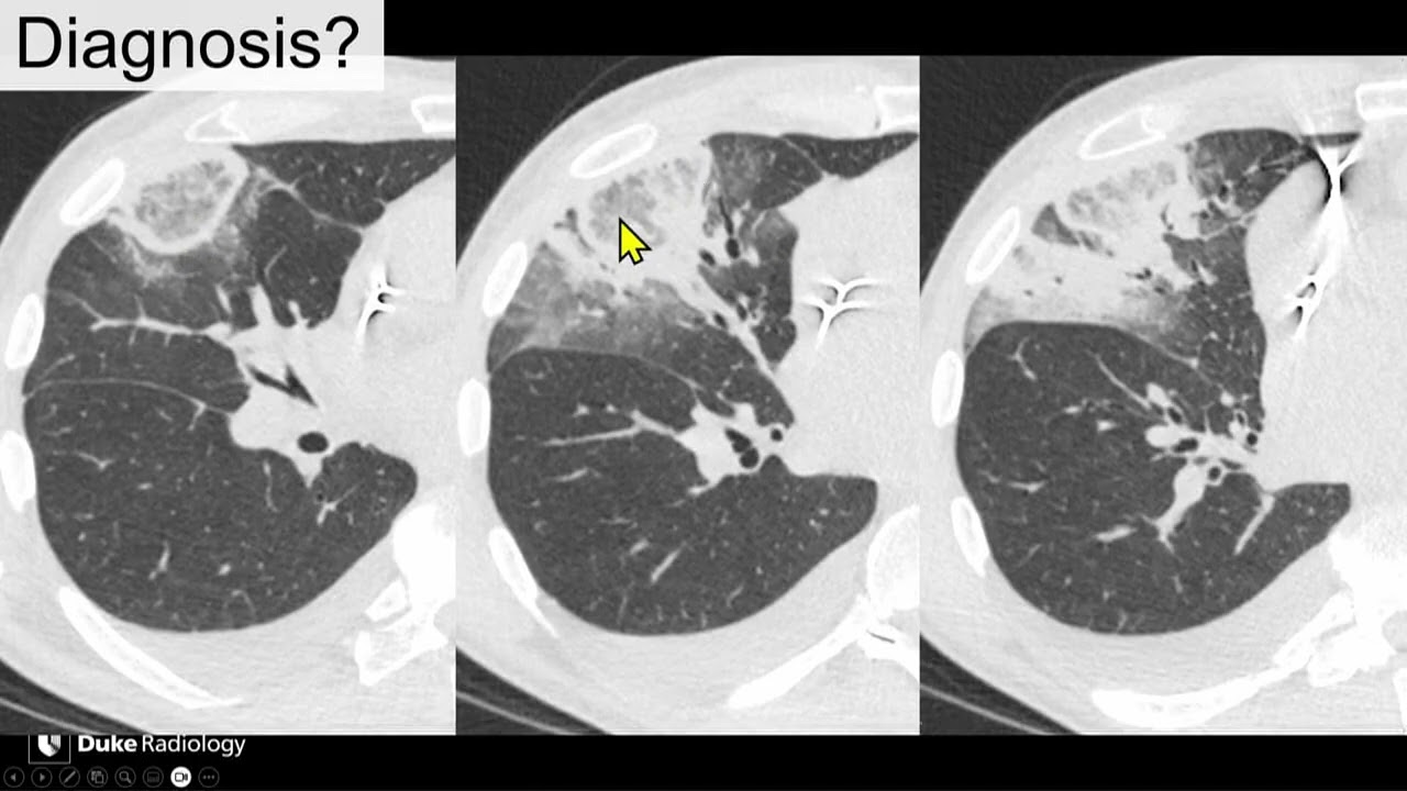 090 Community Acquired Pneumonia – Pearls and Pitfalls GMHS.vn