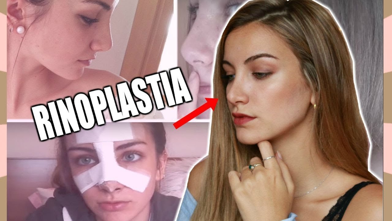 ACTUALIZACIÓN RINOPLASTIA