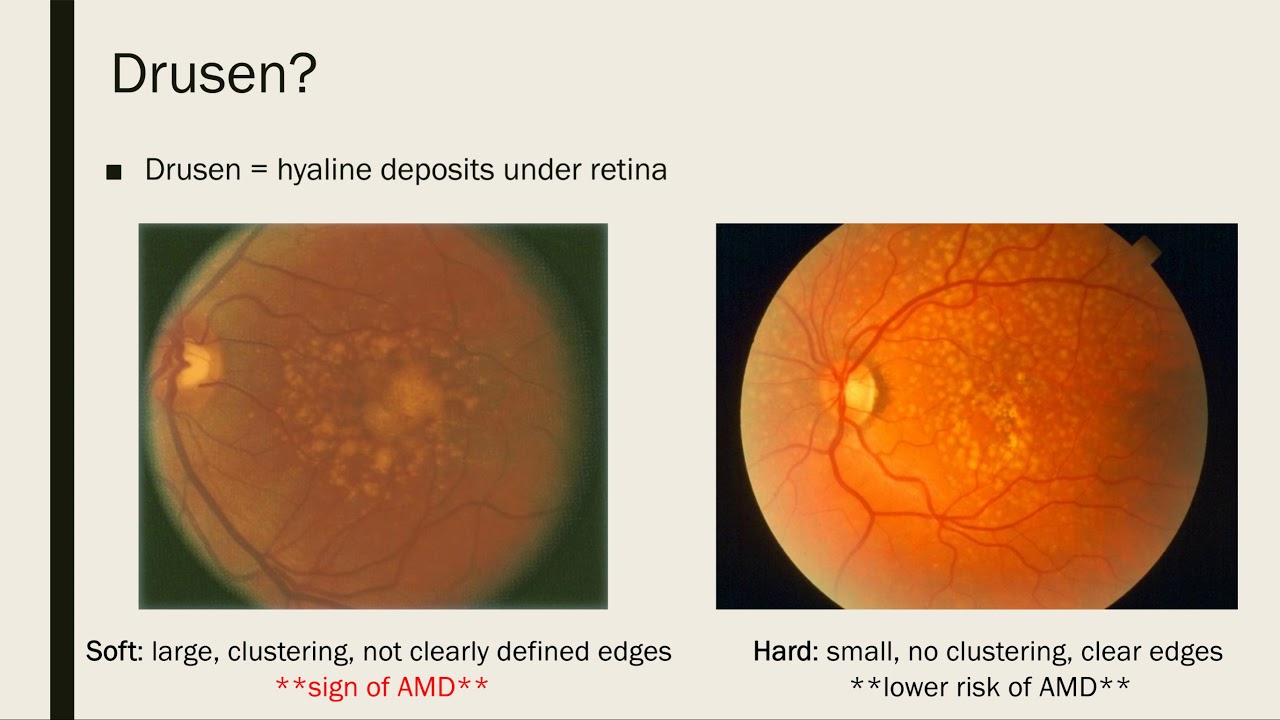 Vision Loss and Macular Degeneration