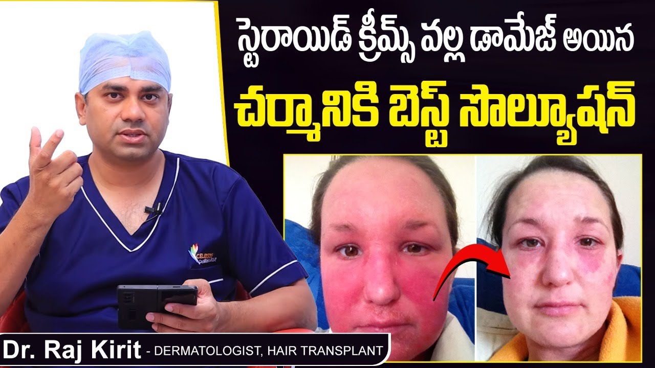 డామేజ్ అయిన చర్మానికి సొల్యూషన్ | How to Recover From Steroid Cream Side Effects | Celestee Clinic