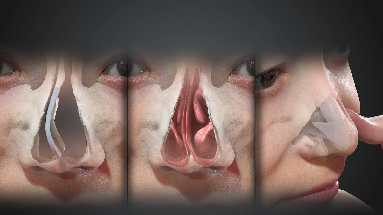 기능코성형 Functional Rhinoplasty Video Animation - Newjean plastic surgery #뉴진성형외과