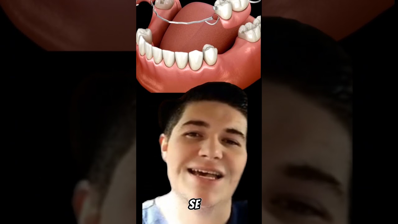 Recupera tus dientes 🦷 con Pr&oacute;tesis Removibles #protesisdental