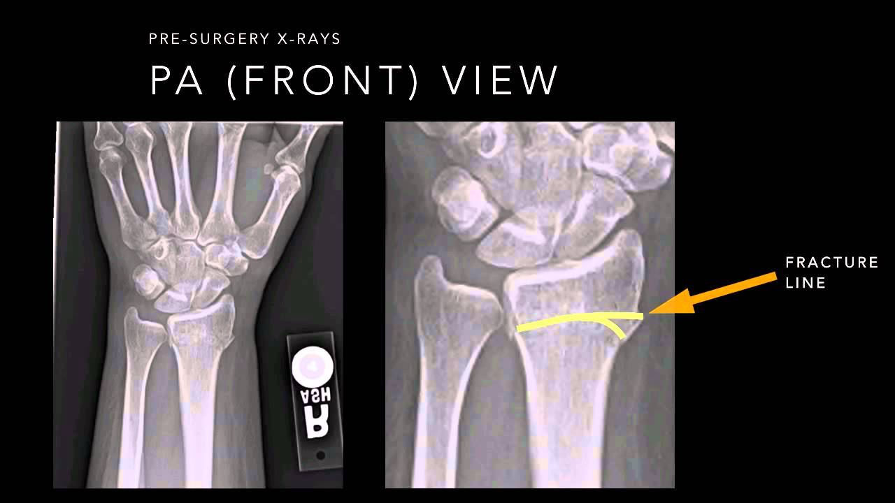 Wrist Fracture X-rays