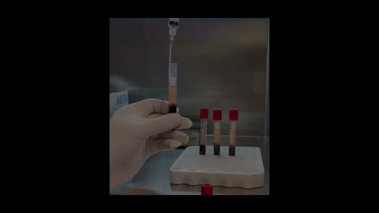 Elaboración de Plasma Rico en Plaquetas y activación con presión negativa.