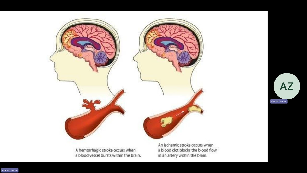Stroke