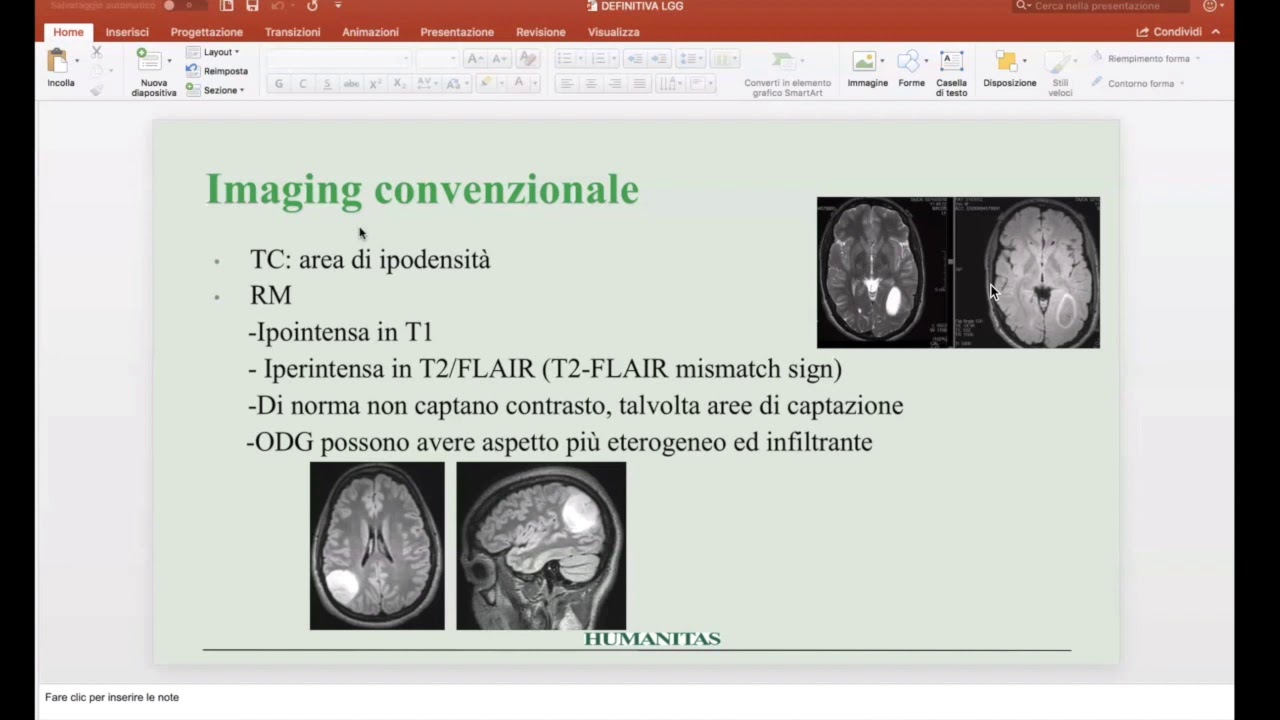 Management dei gliomi a basso grado di malignità