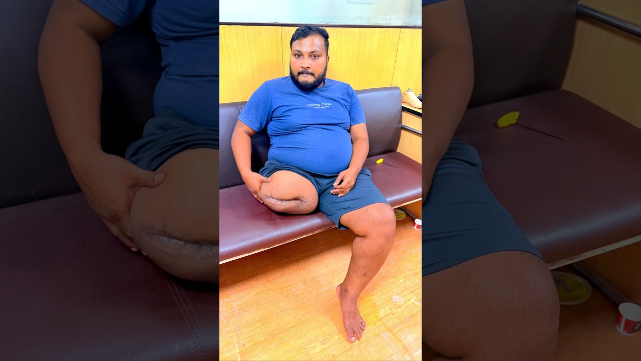 🤯Above Knee Prosthetic Leg | Ossur Pneumatic Knee Joint | Nakli Tang | Ossur Carbon Foot | #ossur