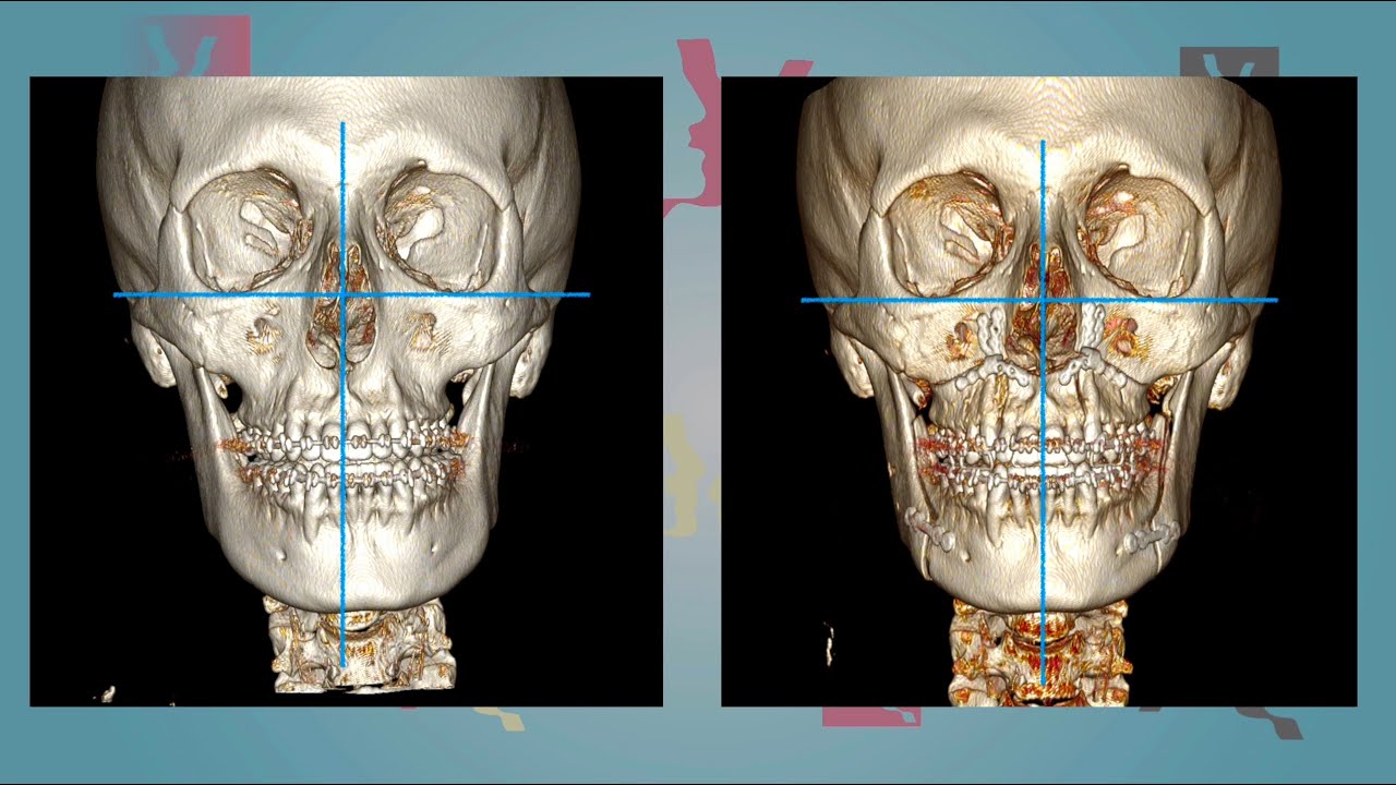 Case 16 - Orthognathic surgery - Facial Asymmetry with class III - English