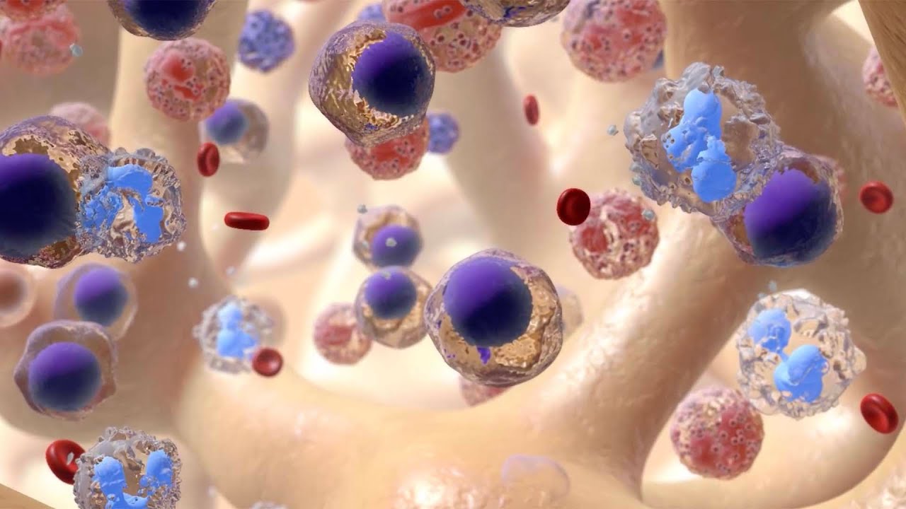 Opciones de tratamiento para la leucemia