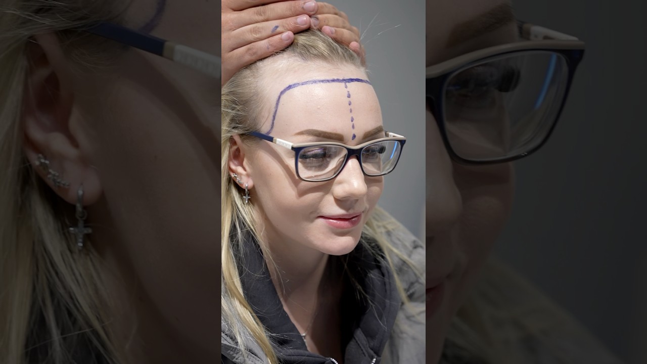 Woman Forehead Reduction Hairline Lowering Surgery in Turkey #shorts #hairtransplant #video