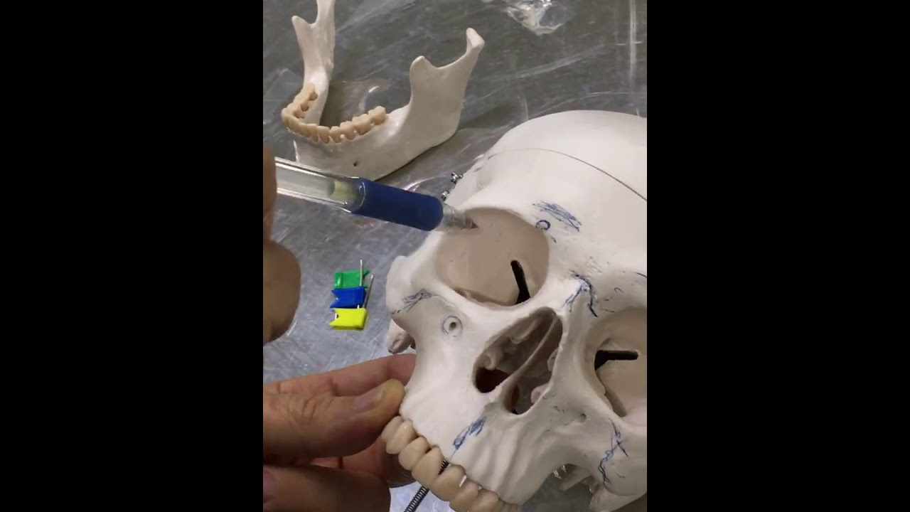 Practical osteology  3 ( skull , normal frontalis ), by Dr. Wahdan