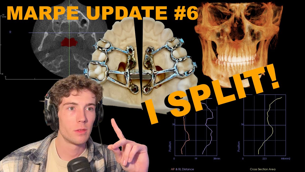 MARPE UPDATE #6 | IM SPLITTING