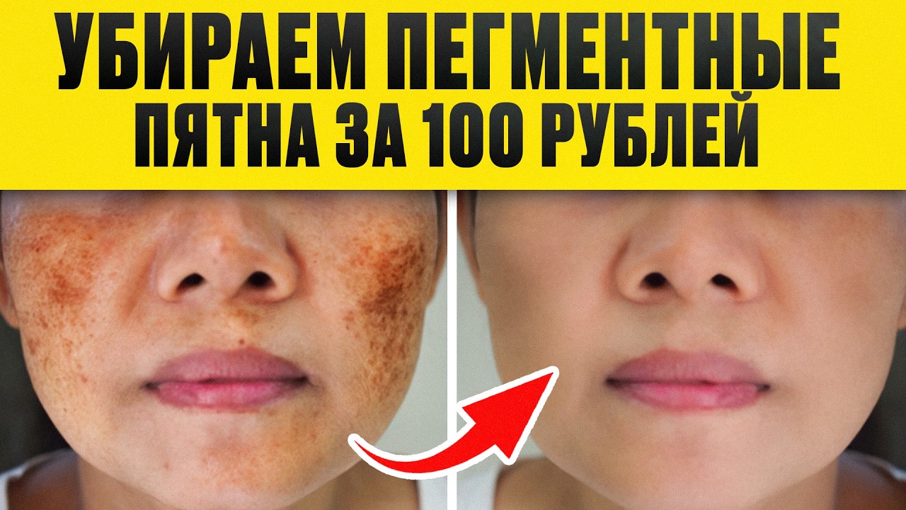 Благодаря ЭТОМУ кожа будет на 10 лет МОЛОЖЕ! / Как избавиться от пигментных пятен?