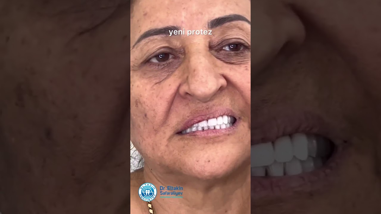 Diş protezi dəyişilərkən üzdə ağız ətrafı nahiyyələrdə mimkida müsbət dəyişiklik