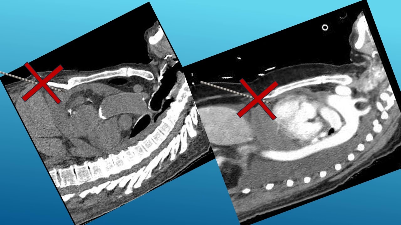 5. Pericardiocentesis - technique