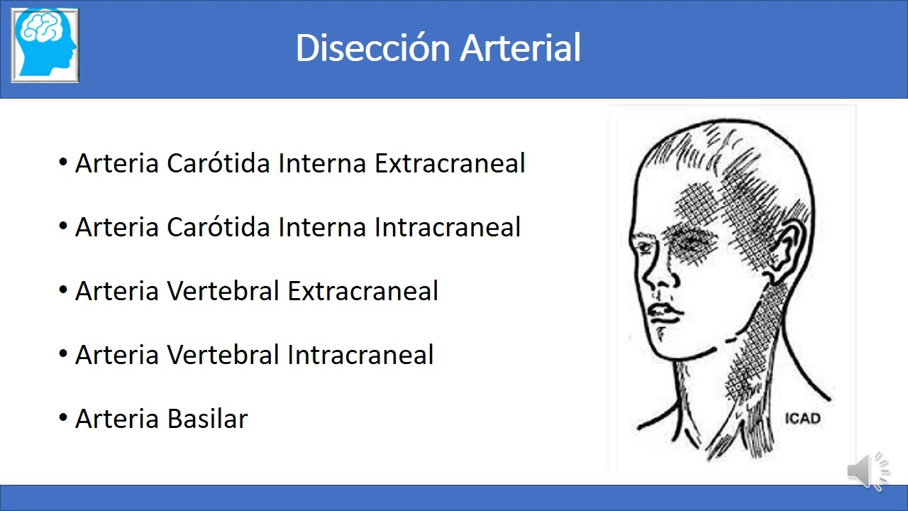 3  ACV isquemico en el Paciente Joven