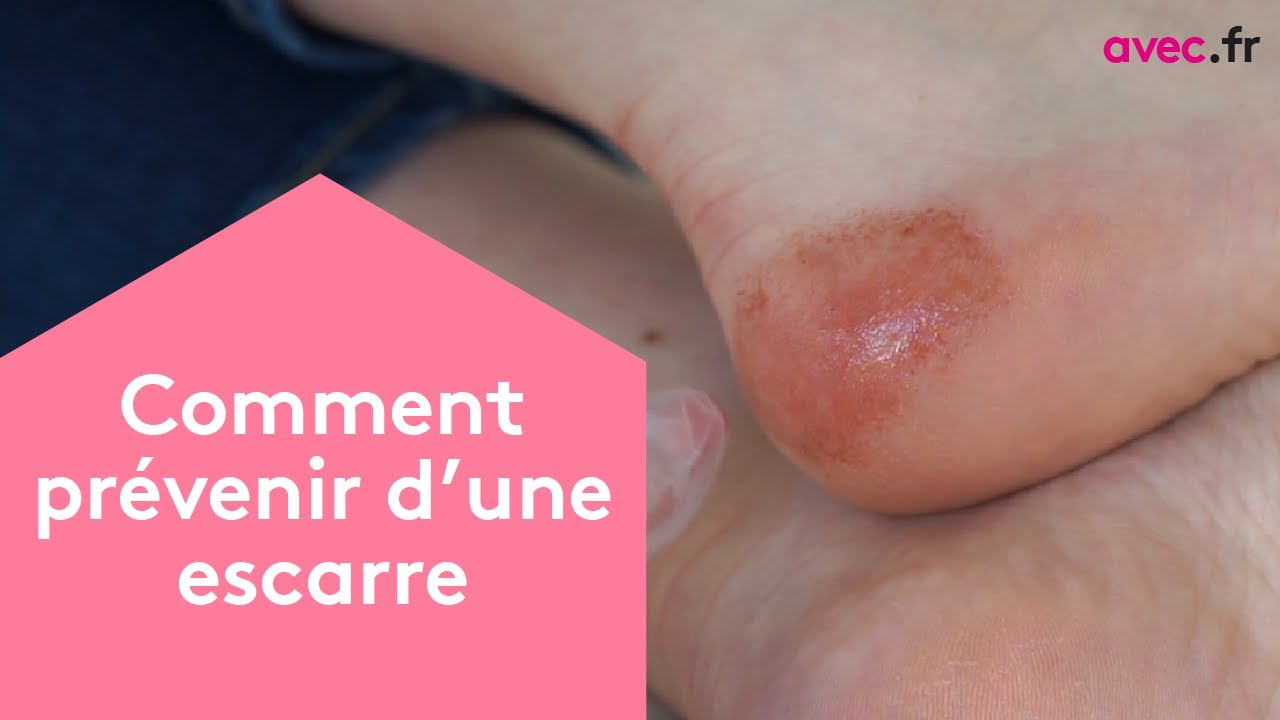 Comment prévenir une escarre ? Formation ADVF