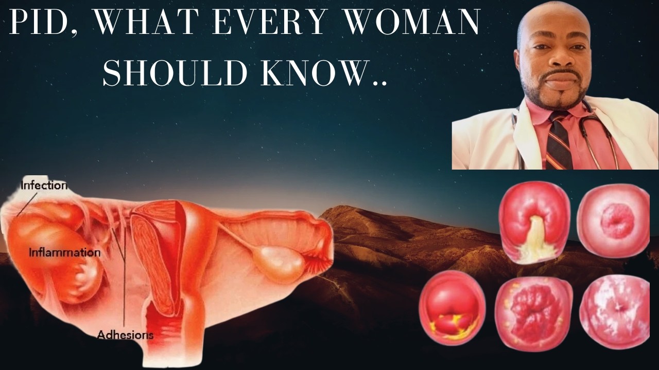 PELVIC INFLAMMATORY DISEASE (PID), WHAT EVERY WOMAN SHOULD KNOW