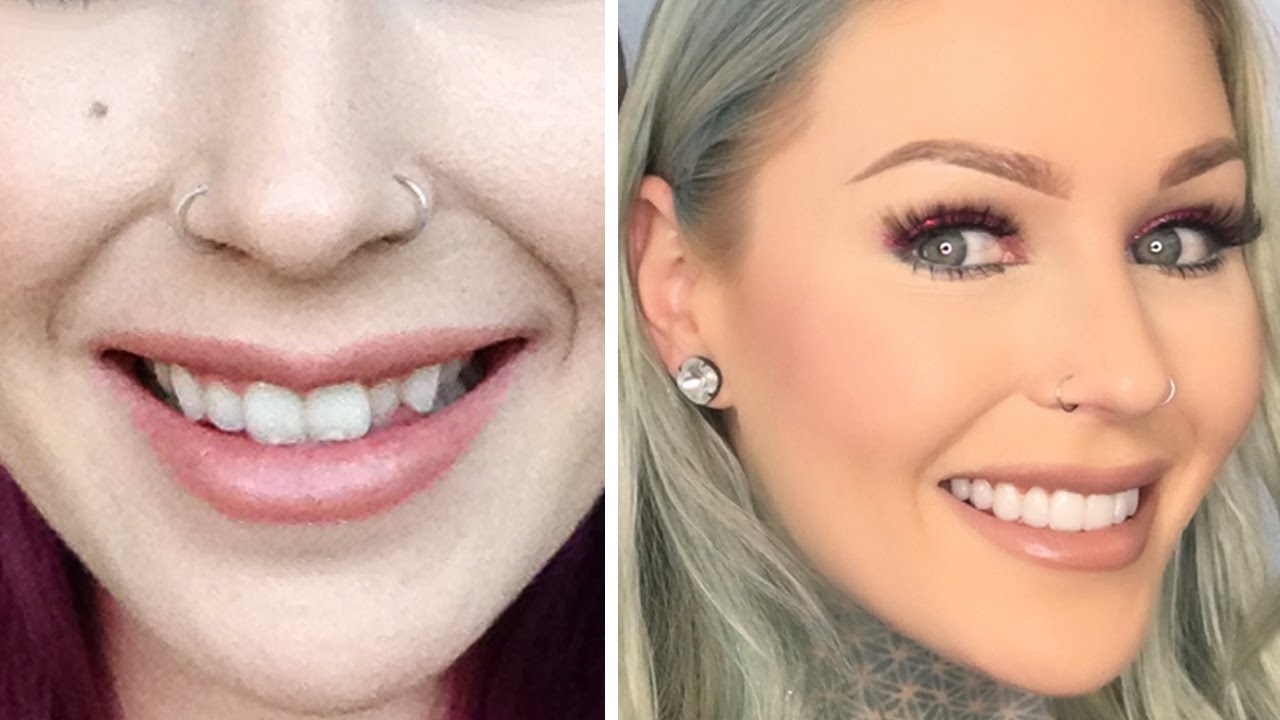 NEW TEETH: Veneers & How I Transformed My Teeth | KristenLeanneStyle