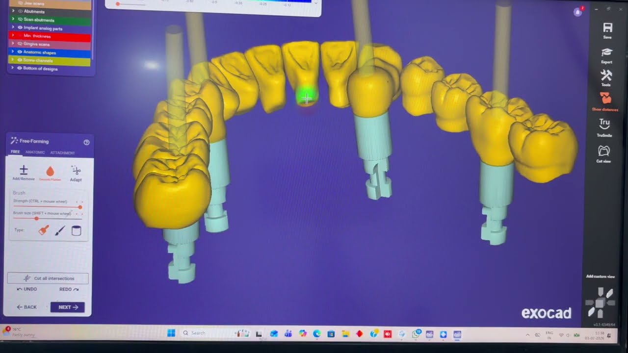 ExoCAD Multi Unit Bridge Design | All-on-4 Workflow with NewDent Implant System
