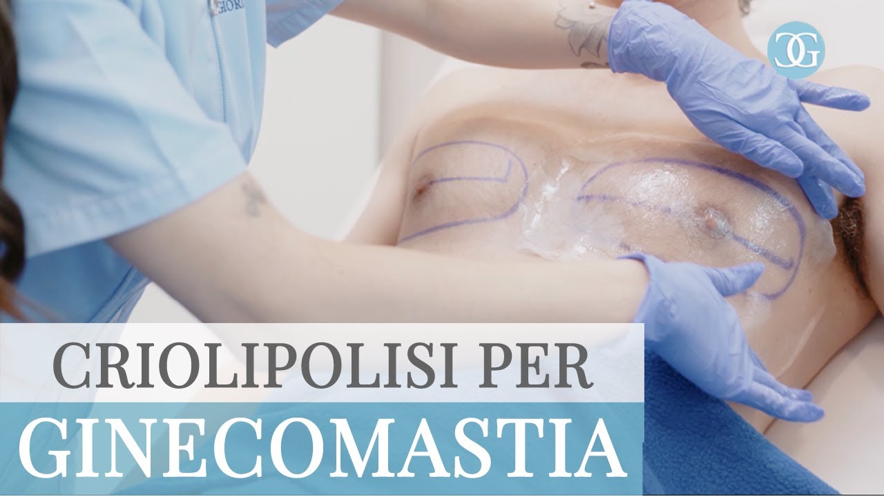 GINECOMASTIA MASCHILE: eliminala senza chirurgia con la Criolipolisi CoolSculpting   Dr.ssa Giorgini