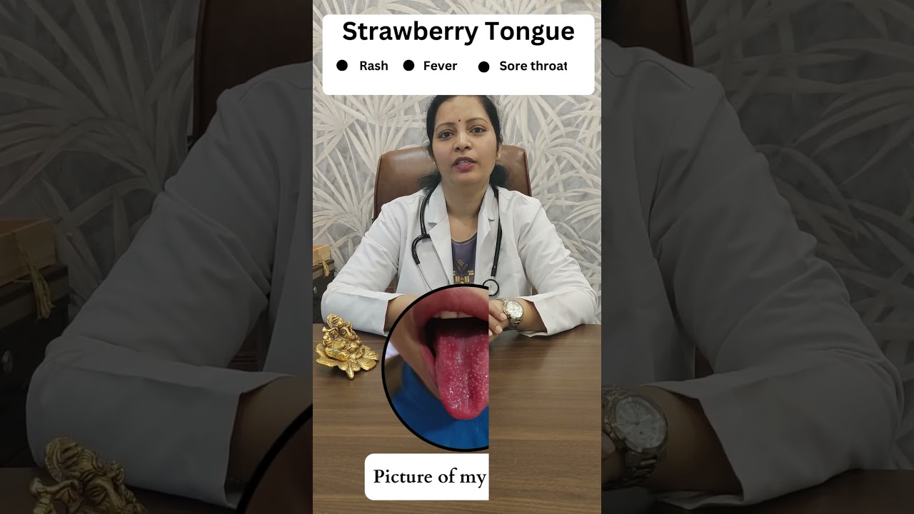 Strawberry Tongue in your child -  Dr. Bhargavi Arun MBBS, MD (Pediatrics)