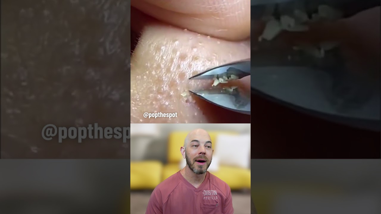 Just a little sebaceous filament plucking to soothe the soul🙂‍↕️ (credit: @popthespot on TT) 
