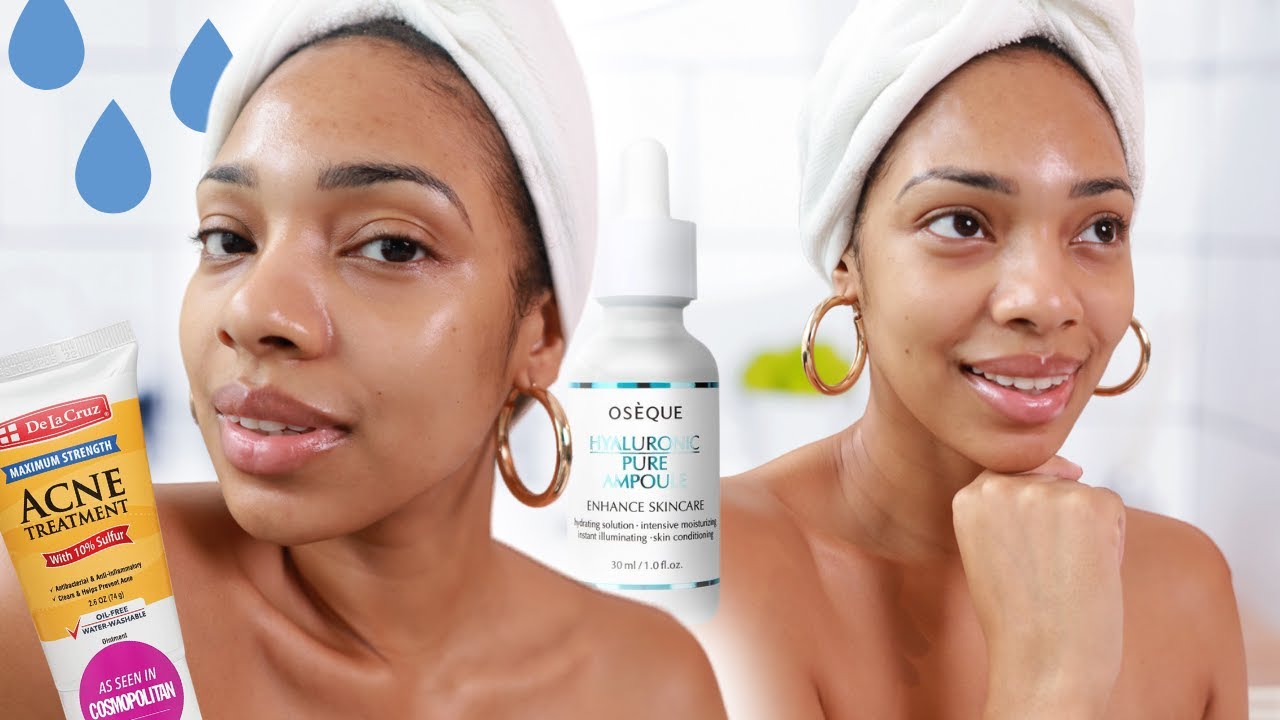Fungal Acne, Closed Comedones, & Dry Skin | Did you over exfoliate or overdo your treatment?