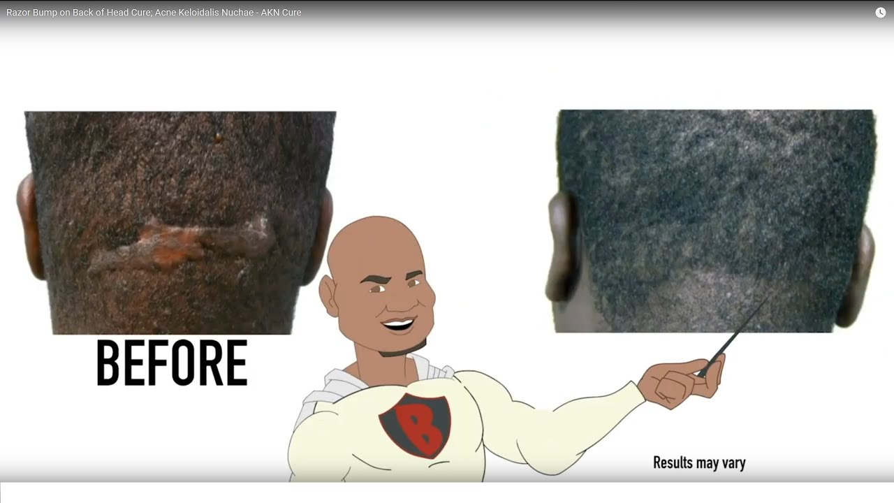 Razor Bump on Back of Head Cure; Acne Keloidalis Nuchae - AKN Cure