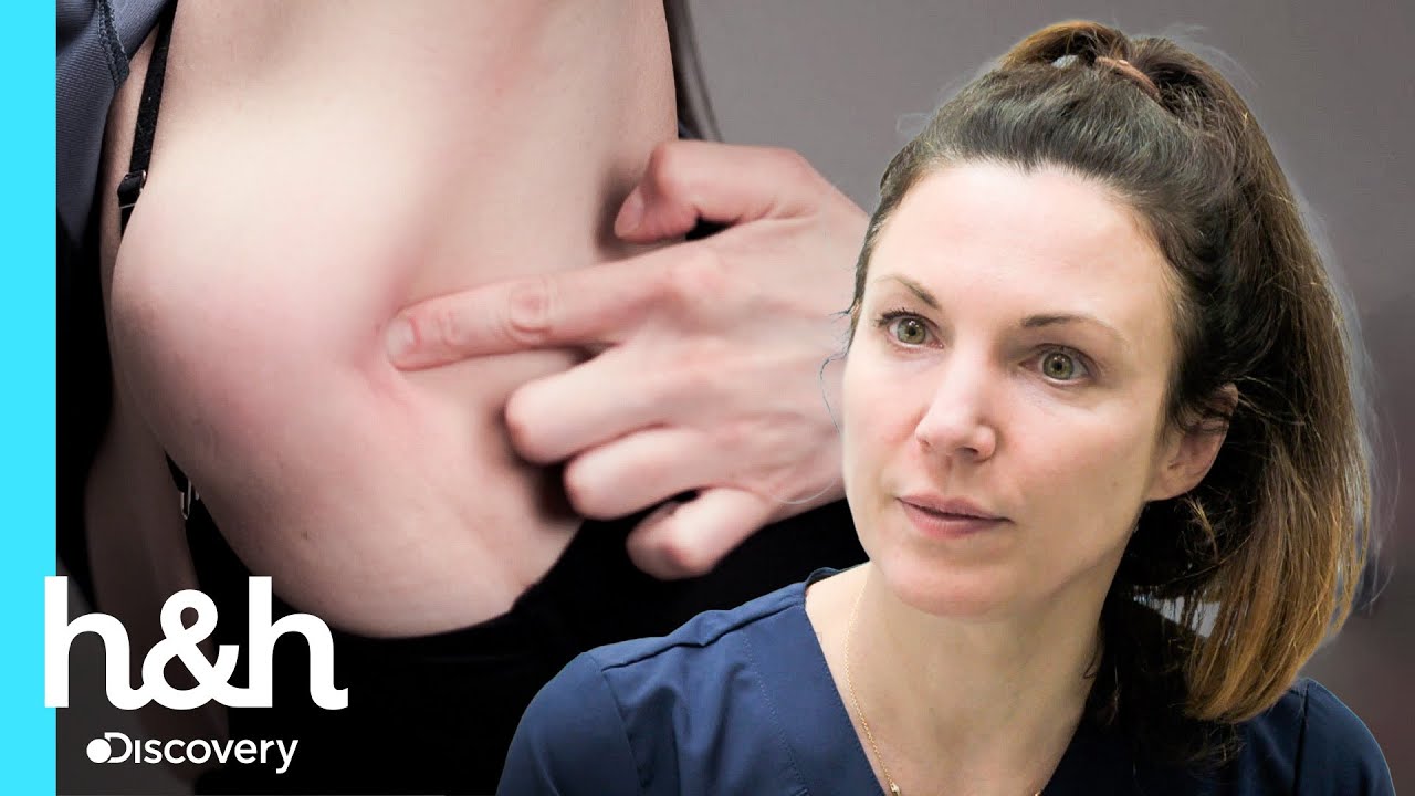 Paciente tem um lipoma no ombro há 7 anos | Dra. Emma: Uma Questão de Pele | H&H Brasil