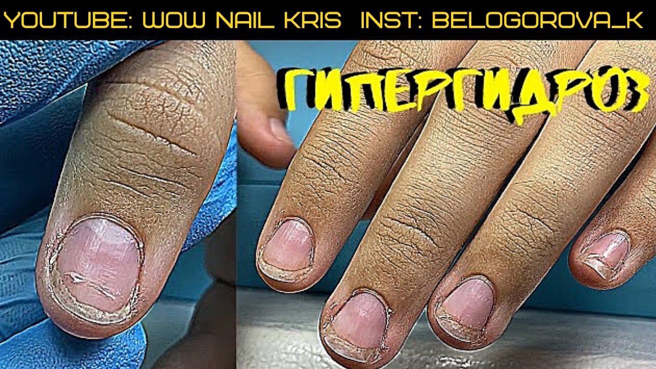 Крутое преображение | НАРАЩИВАНИЕ ПОДРОБНО! Гипергидрозные руки| Лайфкак