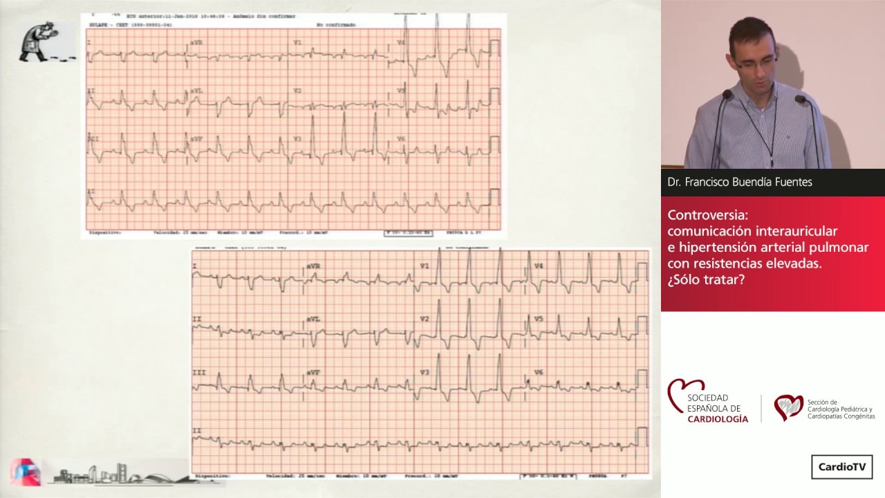 Hipertensión pulmonar: tratamiento en situaciones especiales