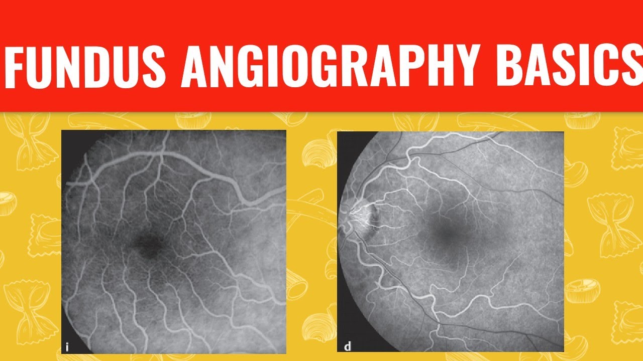 FFA course  || FUNDUS FLUORESCEIN ANGIOGRAPHY ||