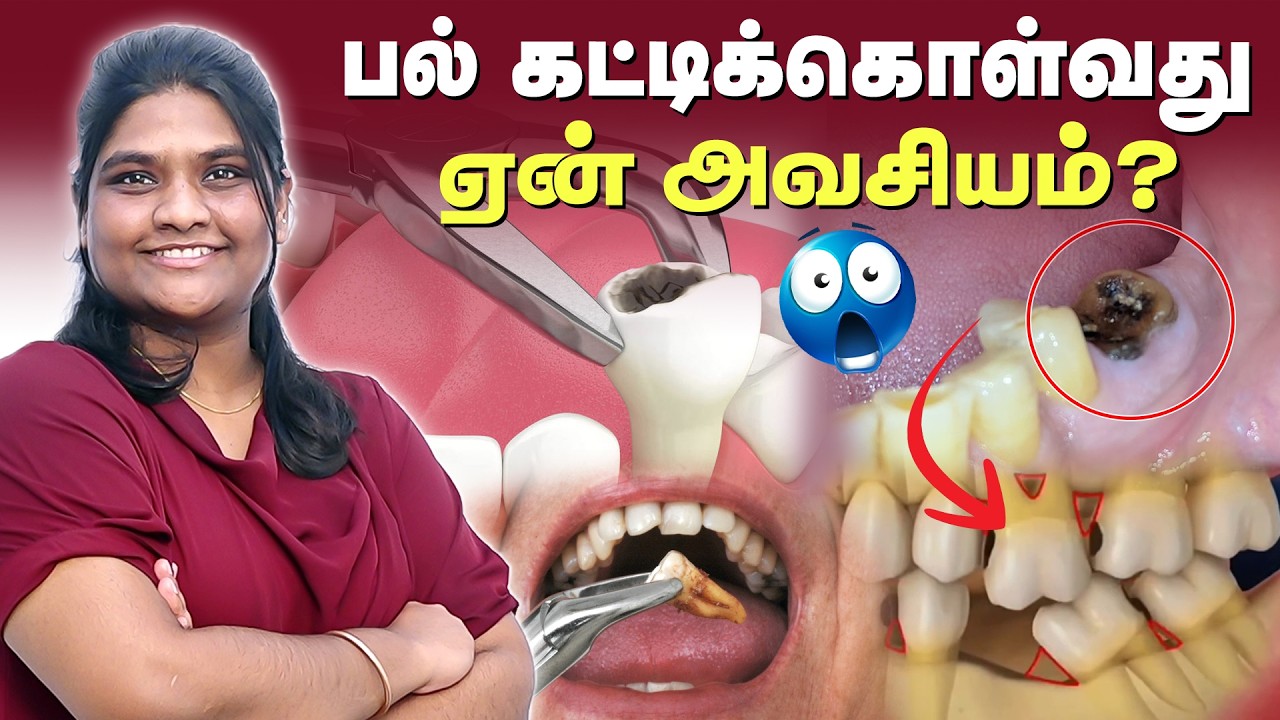 🦷 பல் கட்டிக்கொள்வது ஏன் அவசியம் ? Dentist Explains |  Universe Dental Care