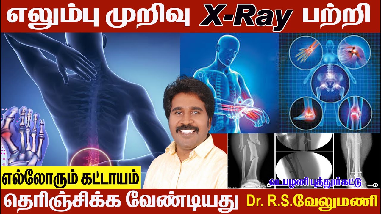 எலும்பு முறிவு பற்றி கட்டாயம் தெரிந்து கொள்ள வேண்டியவை /puttur kattu / Bone setting treatment tamil