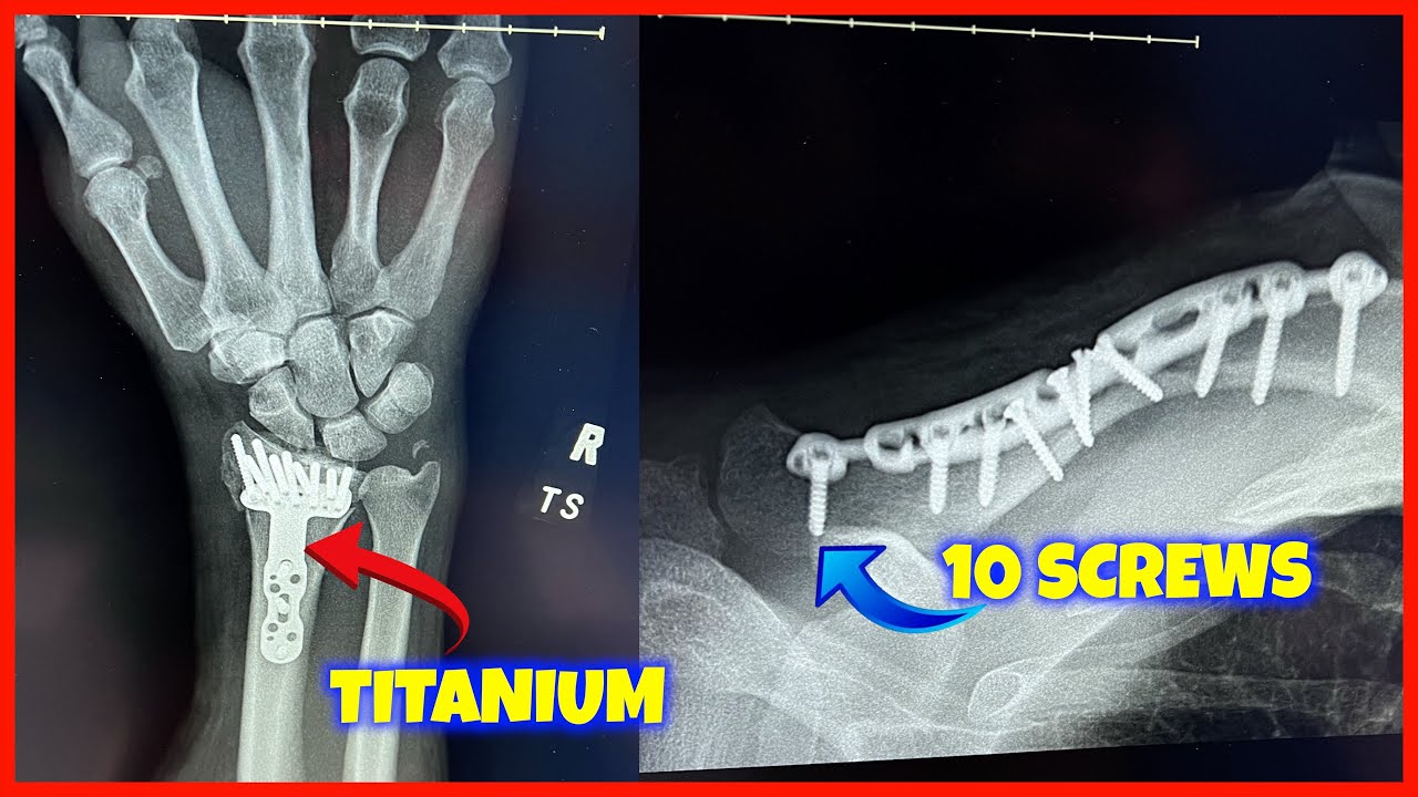 BROKEN WRIST AND COLLARBONE - RECOVERY UPDATE