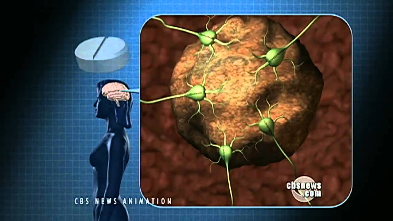 New Brain Cancer Treatment Promising