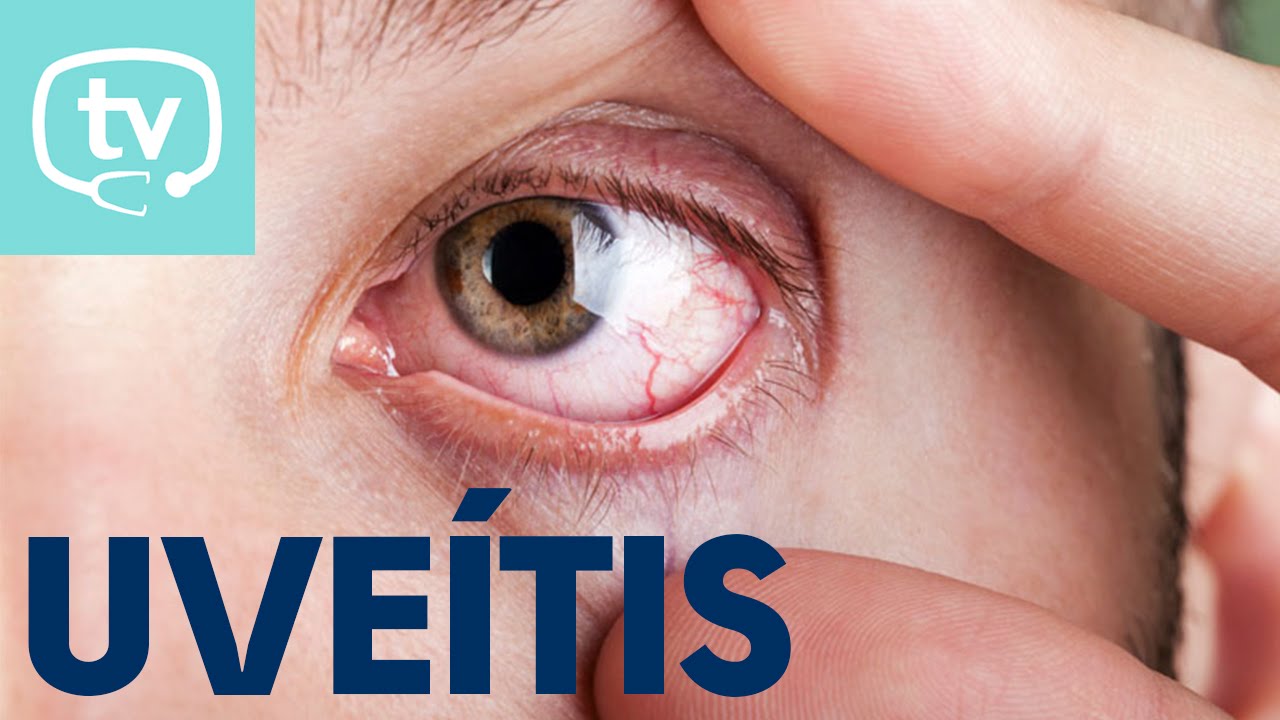 ¿Qué es la uveítis?