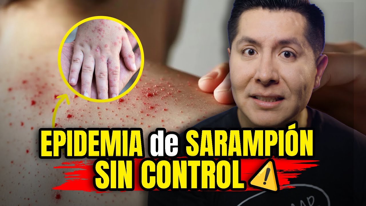 🚨¡ALERTA! BROTE de SARAMPIÓN en MÉXICO 2026: COMO PREVENIR y TRATAMIENTO | Mr Doctor