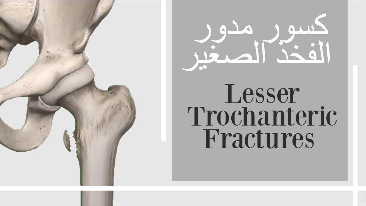 كسر ورك انقلاعي - كسر المدور الصغير للفخذ - lesser trochanteric fractures (subtitled)