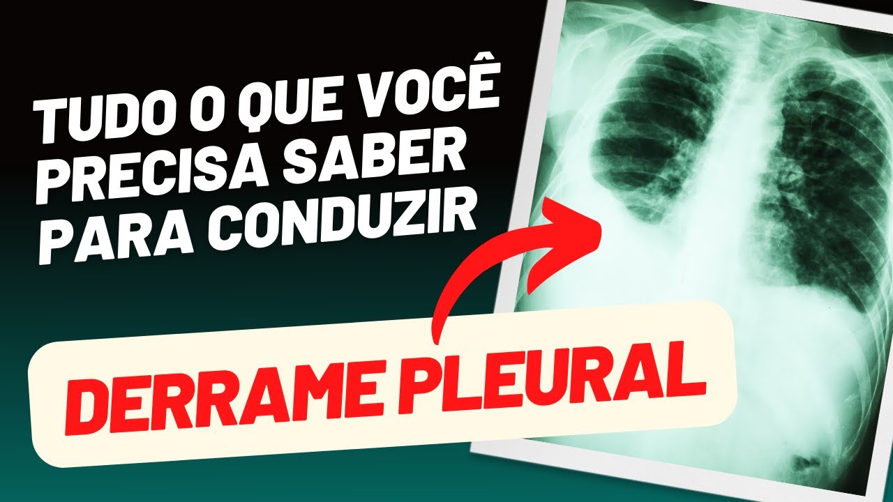 TUDO O QUE VOCÊ PRECISA SABER PARA CONDUZIR DERRAME PLEURAL