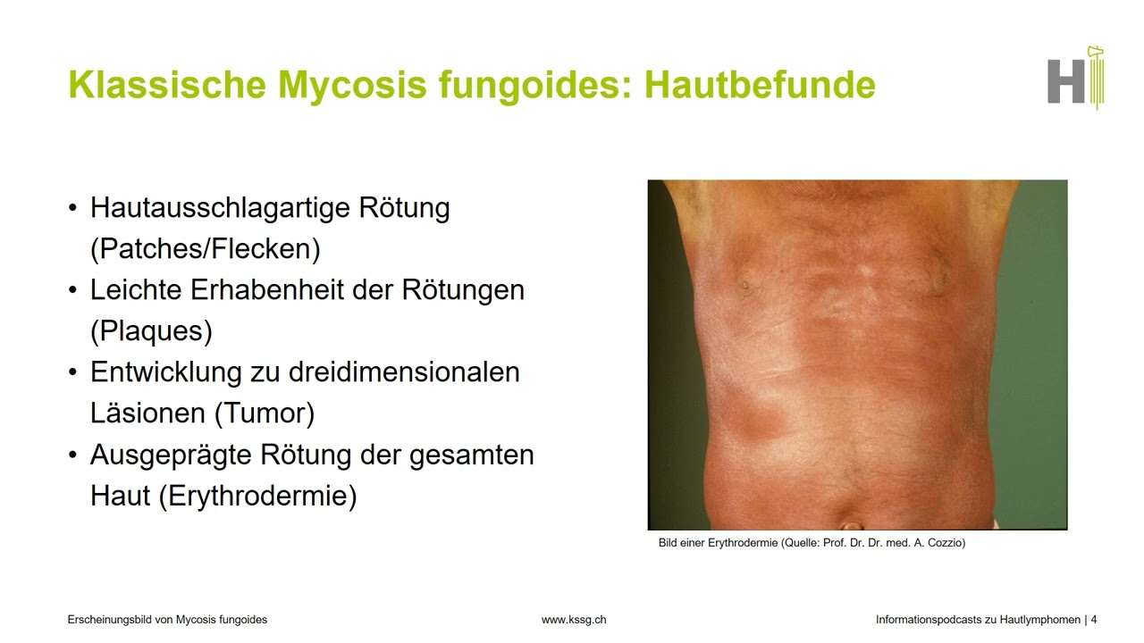 3. Erscheinungsbild der Mycosis fungoides – Präsentationsreihe zu Hautlymphomen