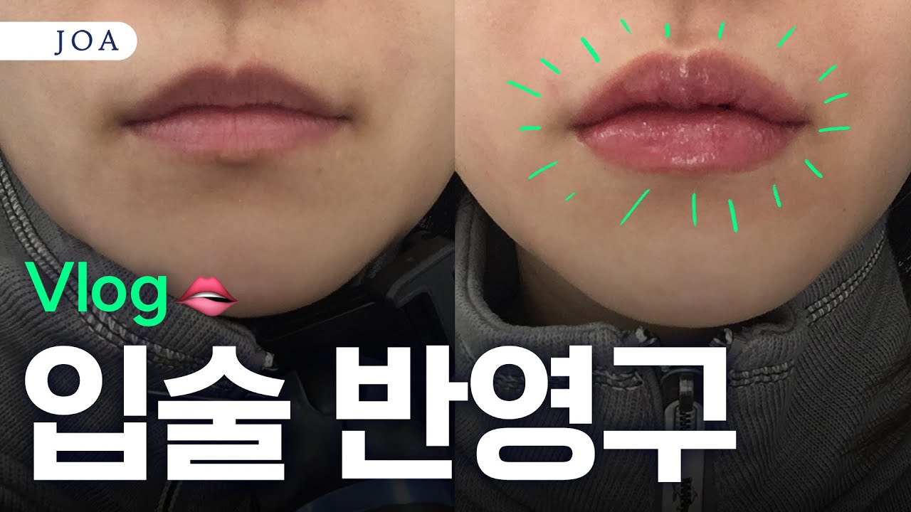 입술반영구 시술, 촬영하다 뽐뿌와서 직접 받아봤습니다!  #조아성형외과 #JOAPlasticSurgery