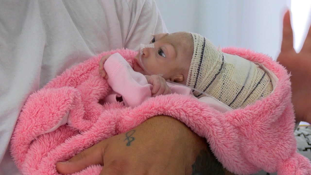 Bebê nasce com duas condições raras ENCEFALOCELE e ACRANIA