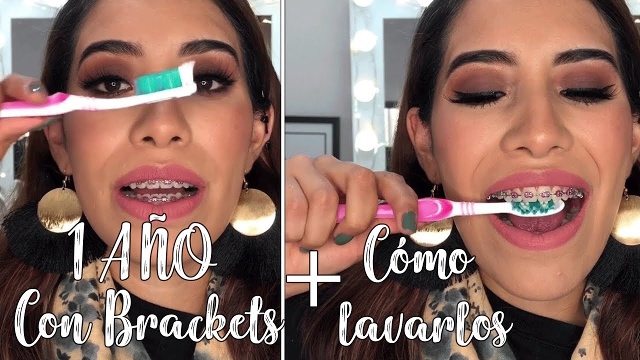 Mi experiencia con brackets 5 +CÓMO LIMPIARLOS | Carel Quezada